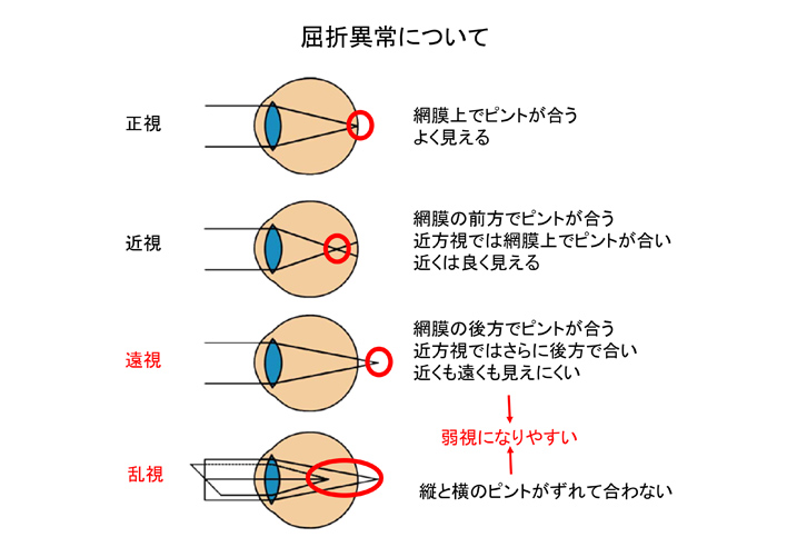 屈折異常について