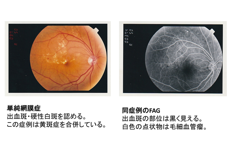 単純網膜症　同症状のFAG