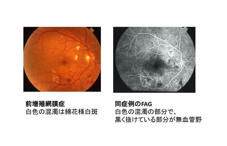前増殖網膜症　同症状のFAG
