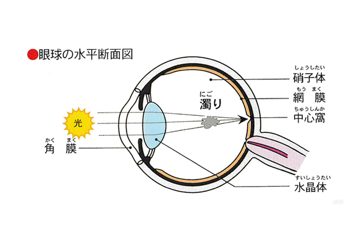 飛蚊症