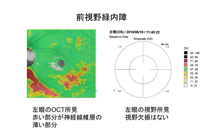 視力の発達